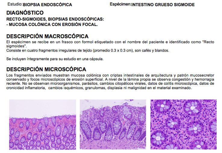 Reporte anatomopatológico con diagnóstico, descripción macroscópica, microscópica e imágenes